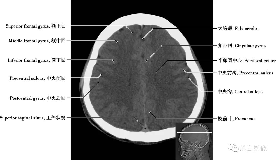 图片[17]-颅脑CT基础：CT断层解剖结构-吃了吃了