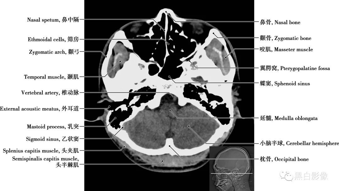 图片[7]-颅脑CT基础：CT断层解剖结构-吃了吃了