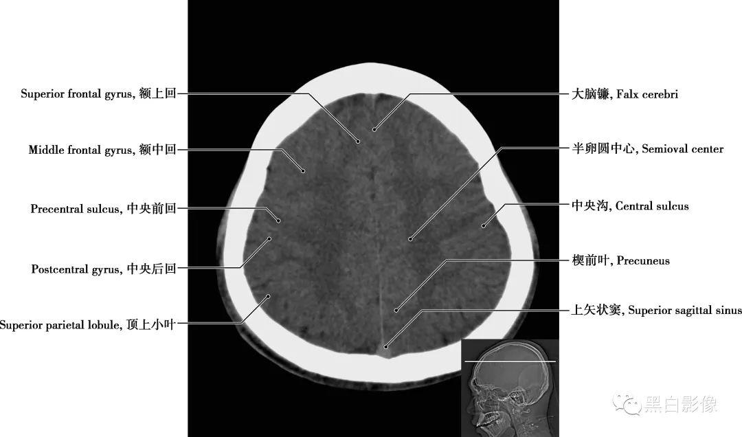 图片[18]-颅脑CT基础：CT断层解剖结构-吃了吃了