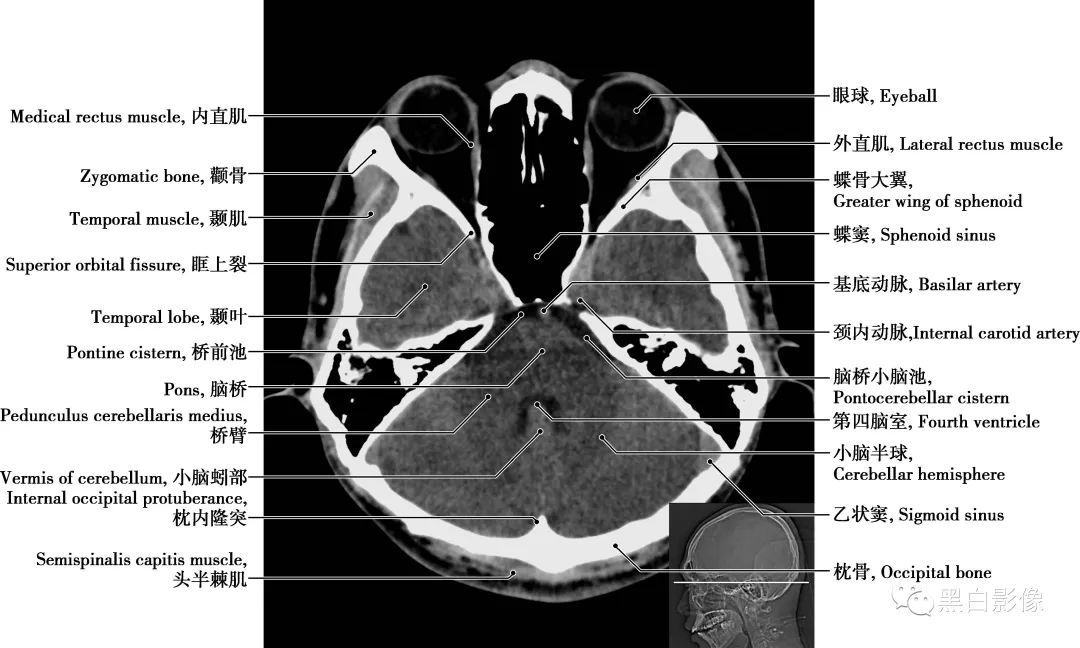 图片[9]-颅脑CT基础：CT断层解剖结构-吃了吃了