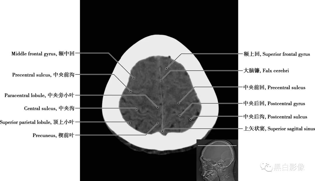 图片[20]-颅脑CT基础：CT断层解剖结构-吃了吃了