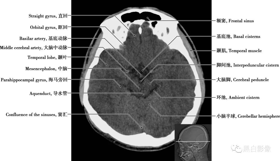 图片[12]-颅脑CT基础：CT断层解剖结构-吃了吃了