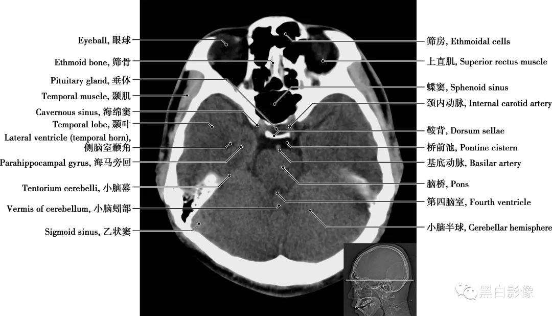 图片[11]-颅脑CT基础：CT断层解剖结构-吃了吃了