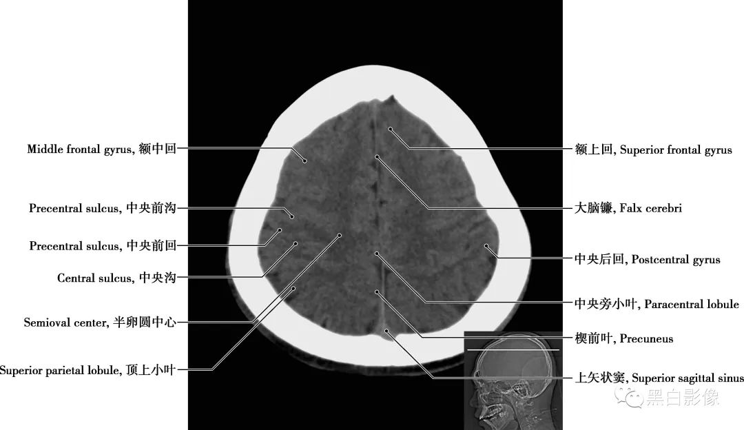 图片[19]-颅脑CT基础：CT断层解剖结构-吃了吃了