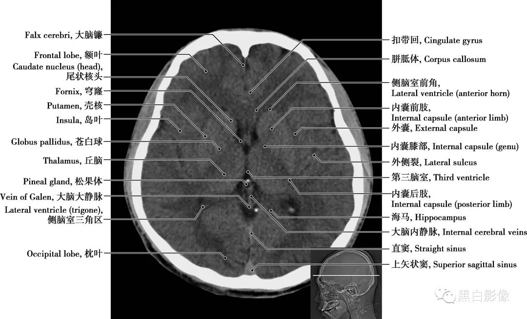 图片[14]-颅脑CT基础：CT断层解剖结构-吃了吃了