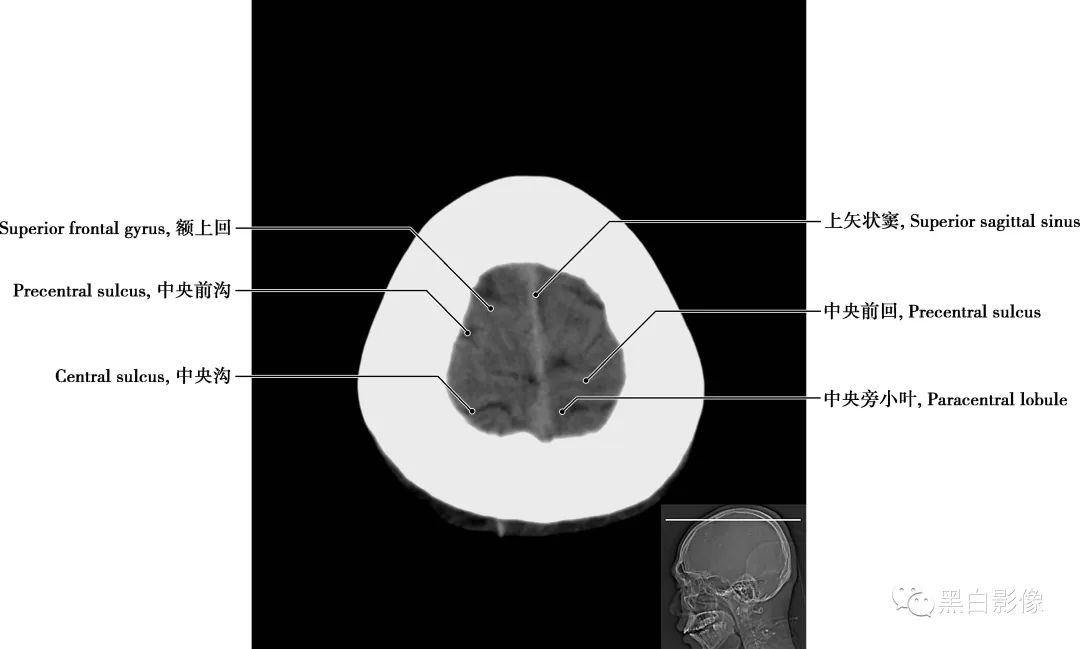 图片[21]-颅脑CT基础：CT断层解剖结构-吃了吃了