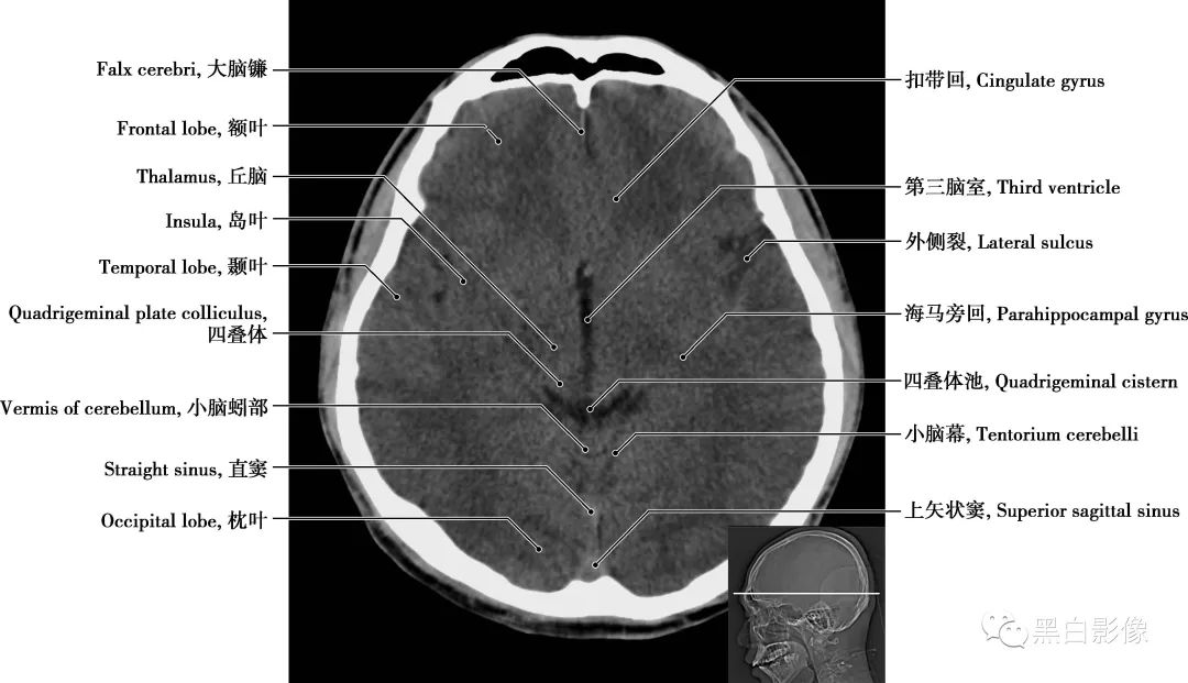 图片[13]-颅脑CT基础：CT断层解剖结构-吃了吃了