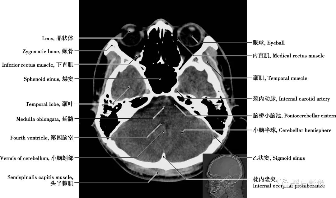 图片[8]-颅脑CT基础：CT断层解剖结构-吃了吃了