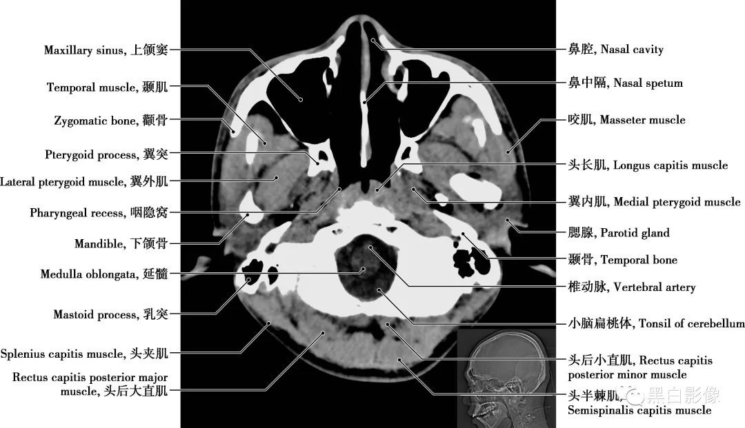 图片[3]-颅脑CT基础：CT断层解剖结构-吃了吃了