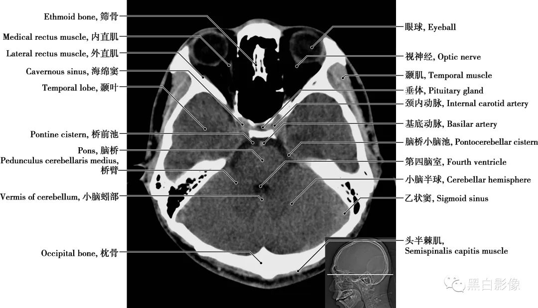 图片[10]-颅脑CT基础：CT断层解剖结构-吃了吃了