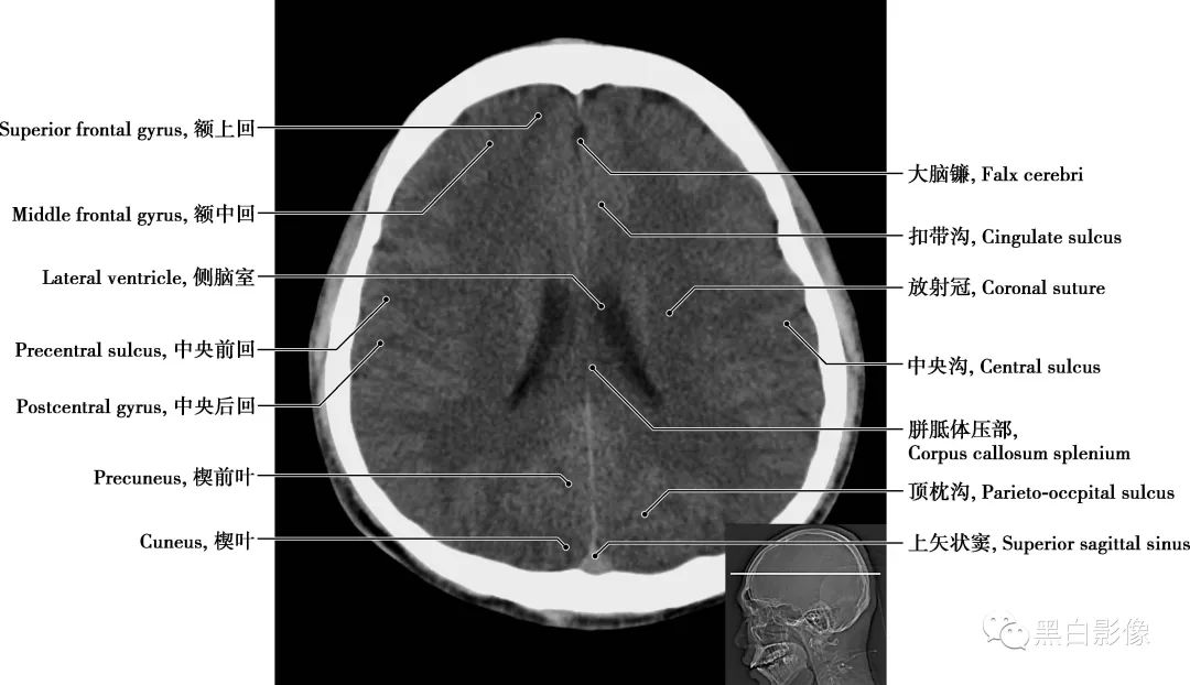 图片[16]-颅脑CT基础：CT断层解剖结构-吃了吃了
