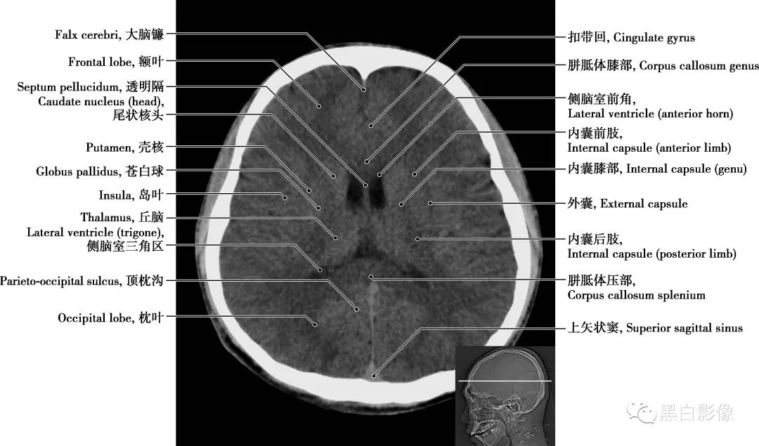 图片[15]-颅脑CT基础：CT断层解剖结构-吃了吃了